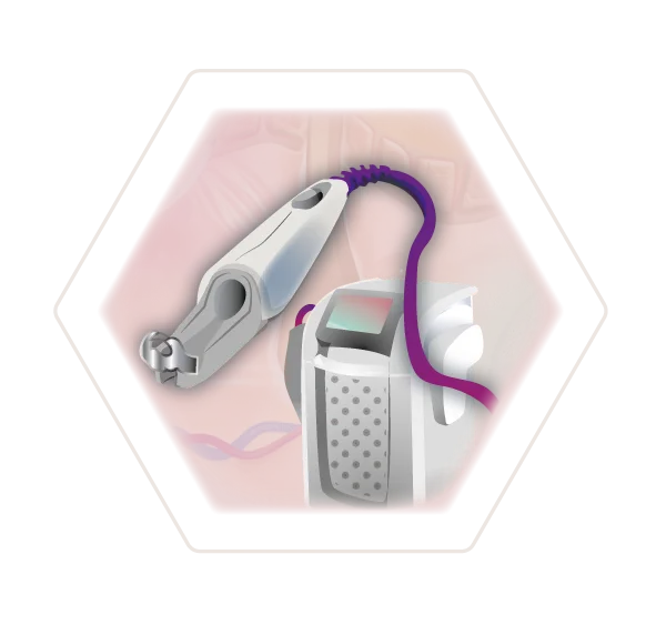 Illlustration Alexandritlaser